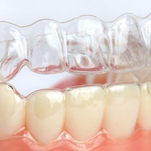 Upper & Lower Retainers