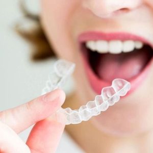 Dental Retainers Upper